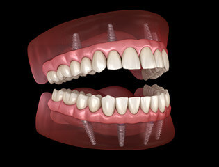 implant dentistry 2