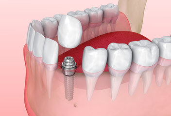 implant dentistry 1