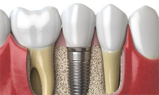 Dental Implant Treatment