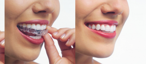 Invisible Brackets and Invisalign® Treatments