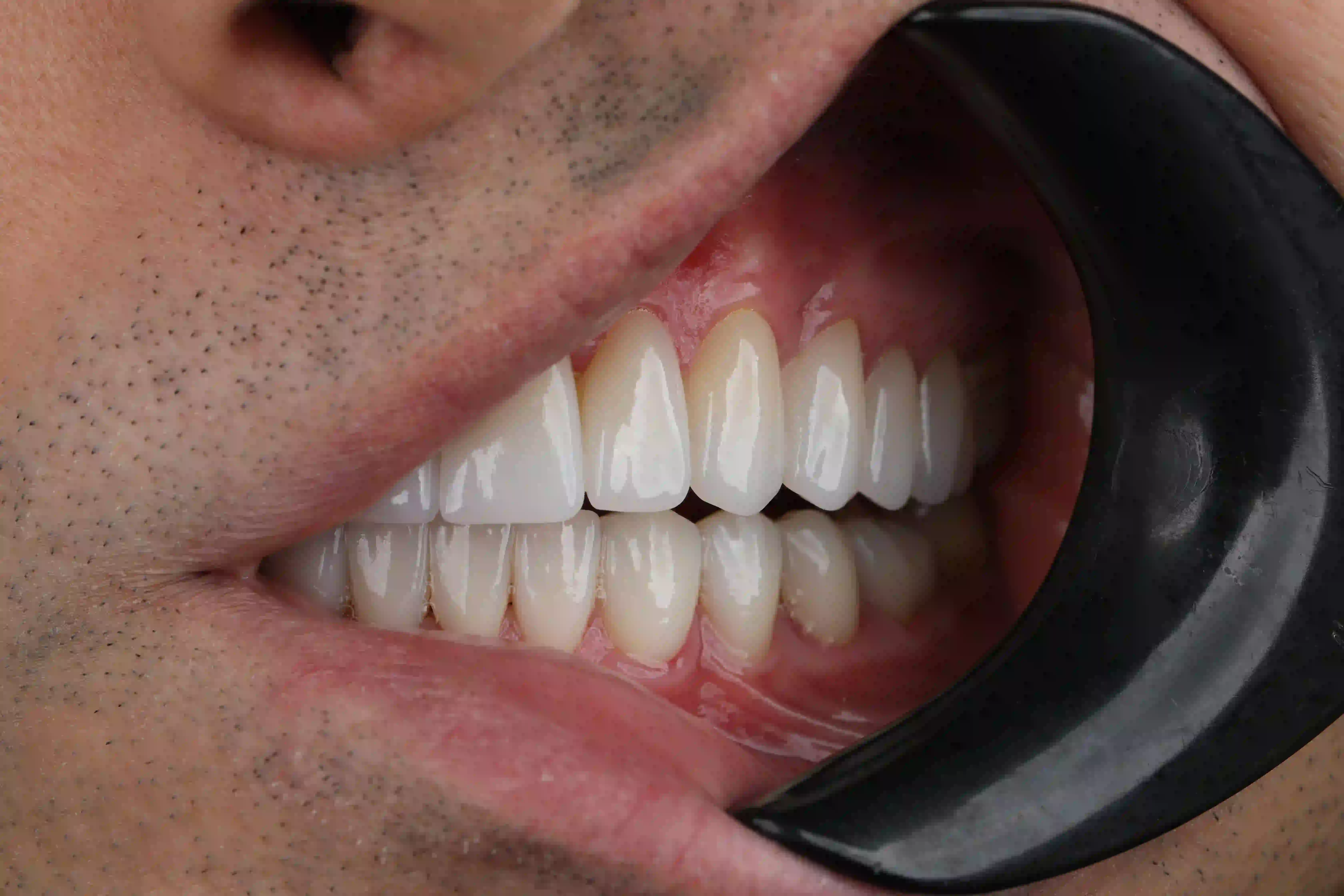 Close-up zirconia restoration appearance at Bergedent Istanbul