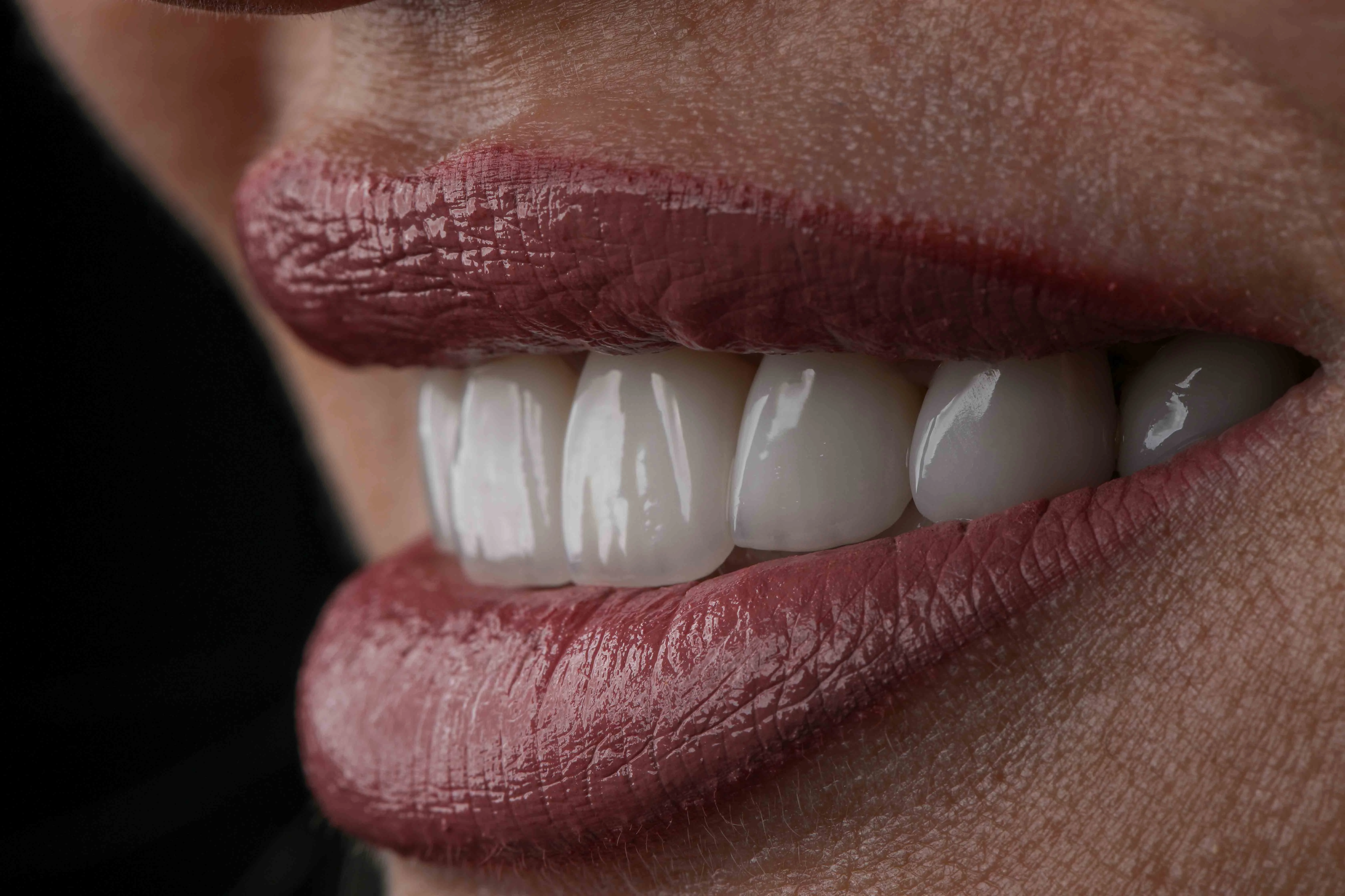 Close-up esthetic dentistry smile detail at Bergedent