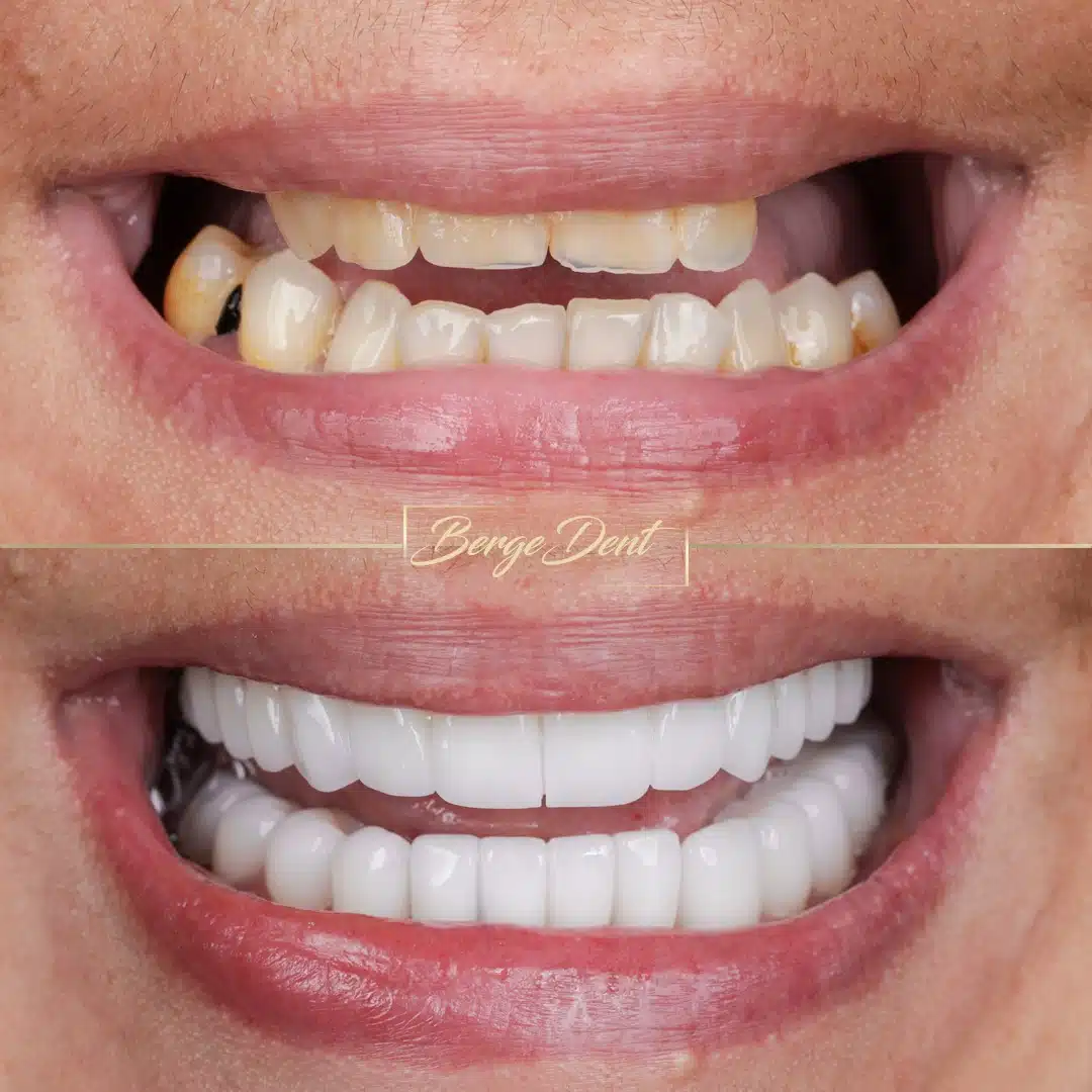 Implant-supported full-arch restoration result at Bergedent Istanbul