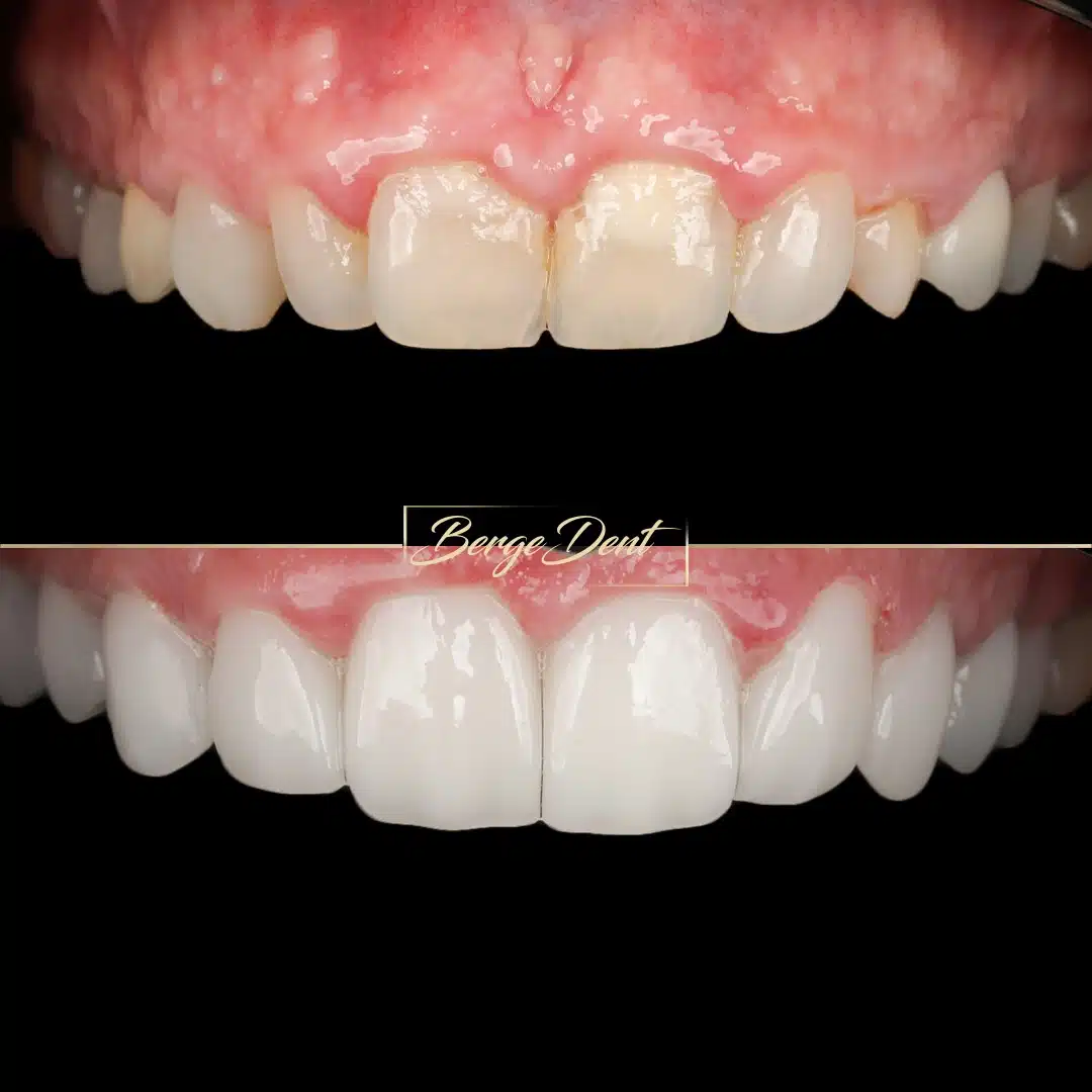 Natural smile result after full-mouth rehabilitation at Bergedent
