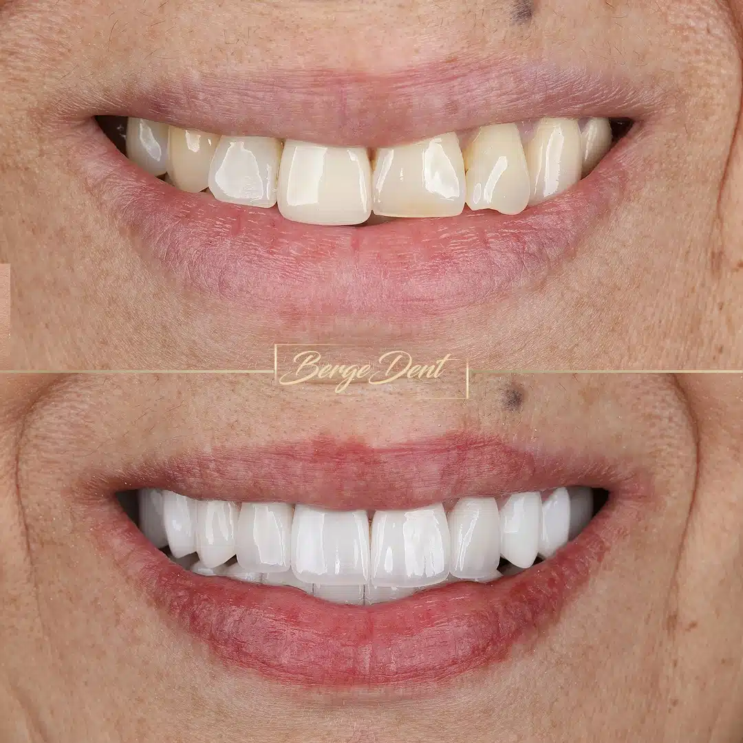 Close-up veneer result at Bergedent