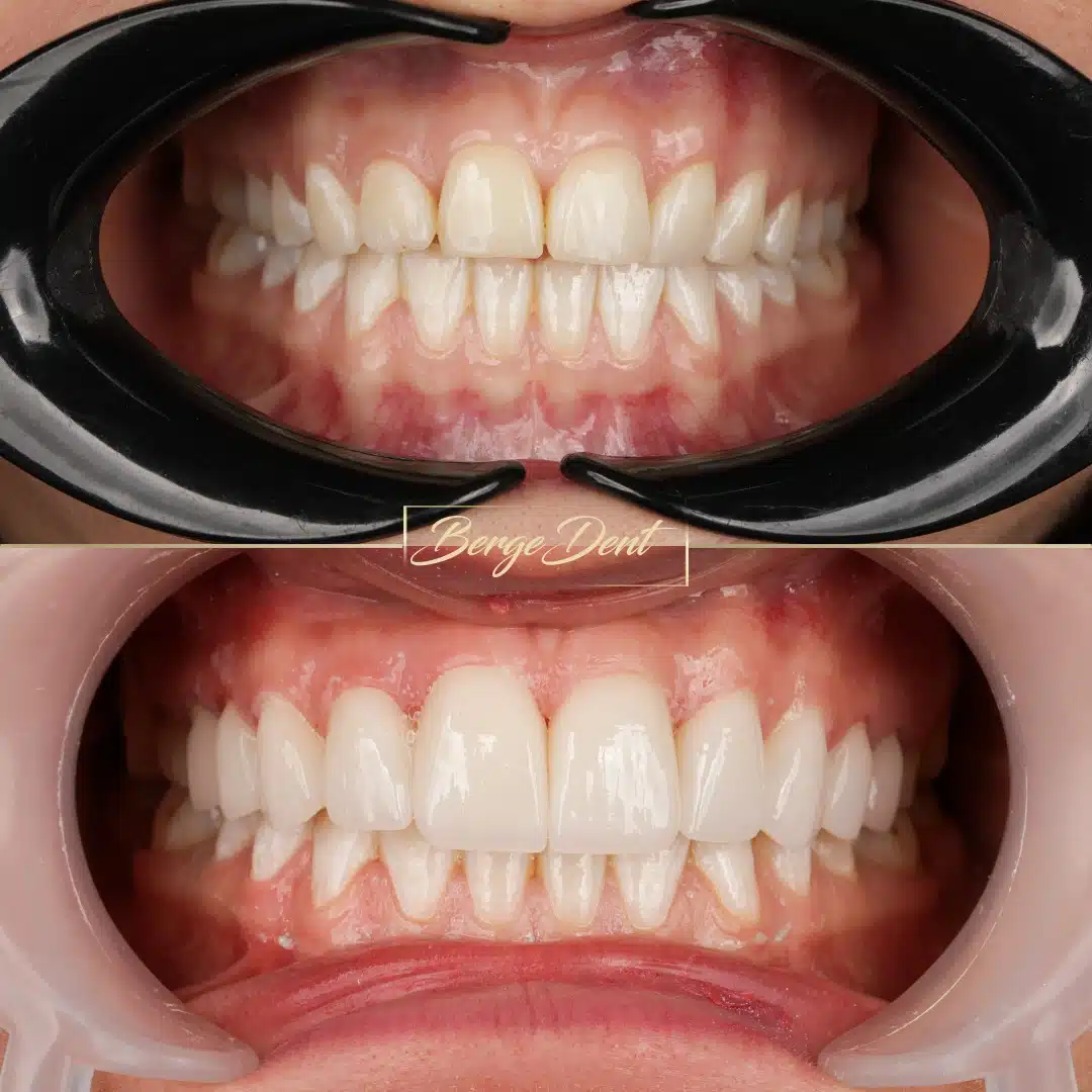 Natural full smile result with zirconia crowns at Bergedent